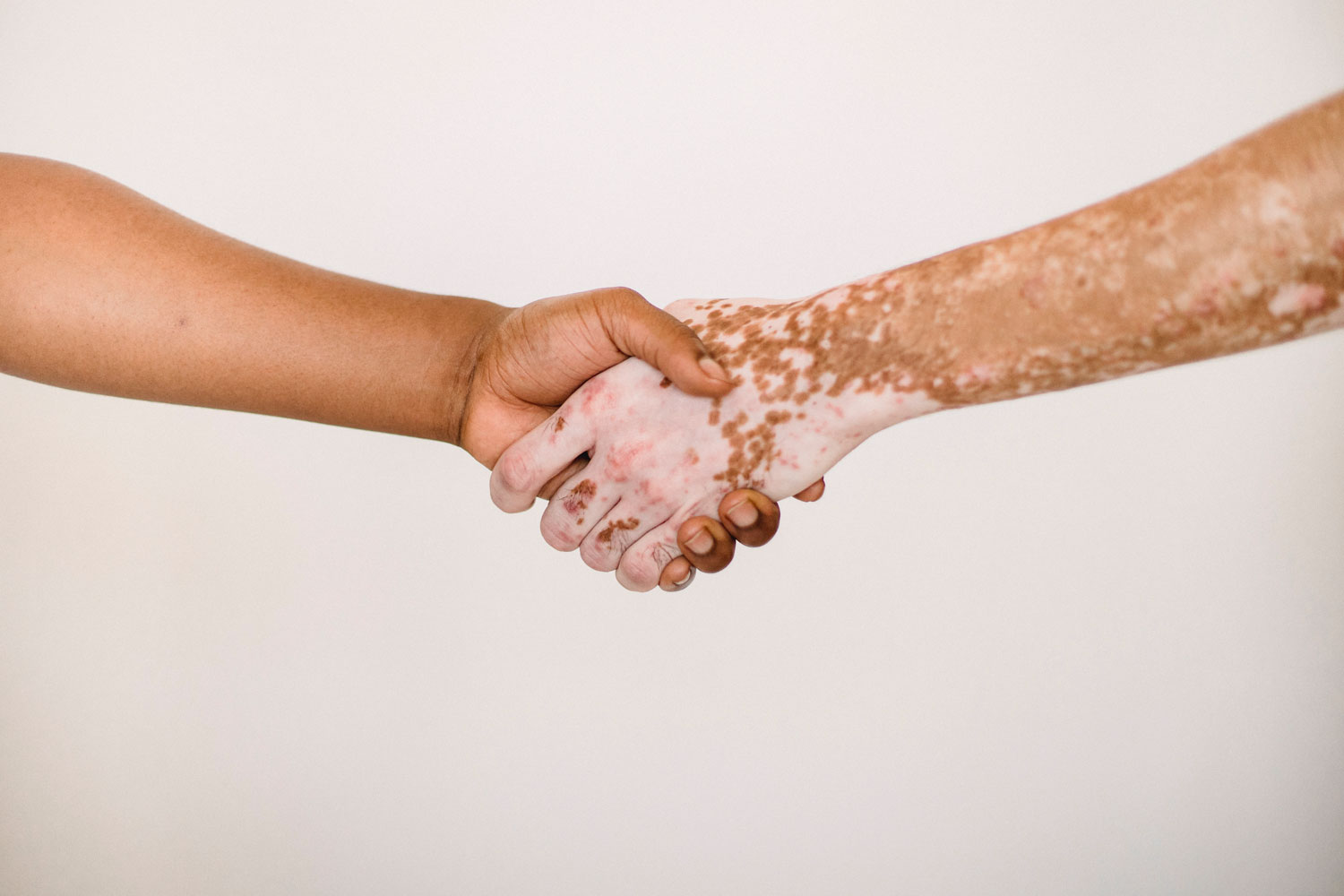 Vitiligo-Symptoms-+-What-Exactly-To-Do-About-Them